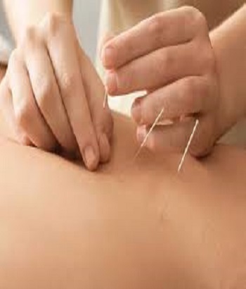 Dry Needling Therapy